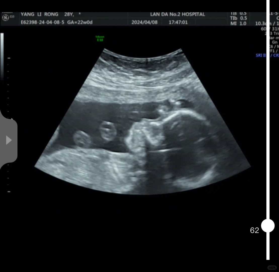 剖腹产后半年内分阶段瘦身方法，剖腹产后如何通过饮食减肥